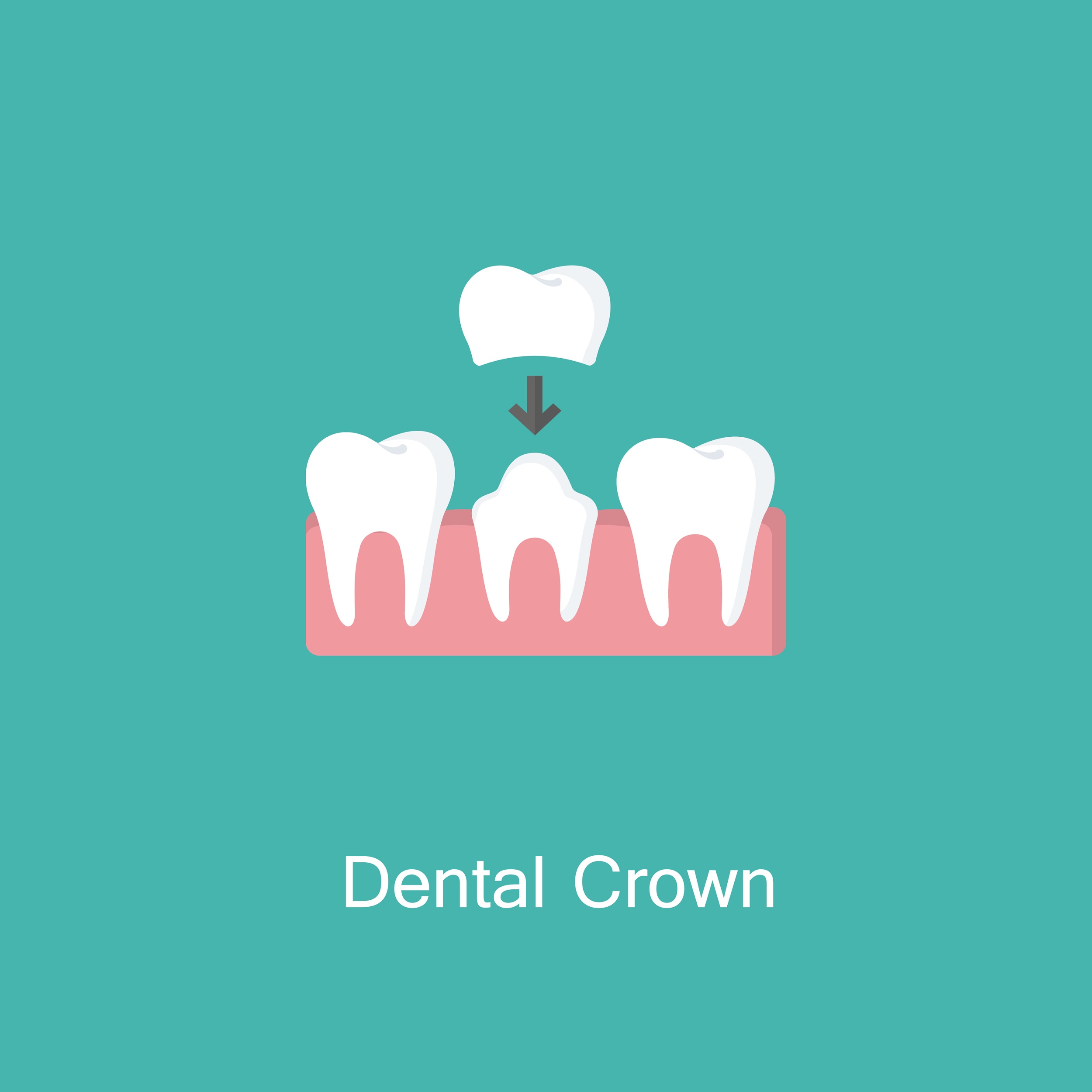 Illustration of dental crown being placed on a damaged tooth