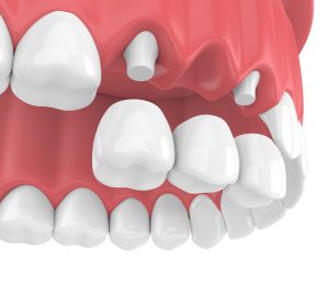 Digital rendering of tooth bridge being placed on anchoring dental implants