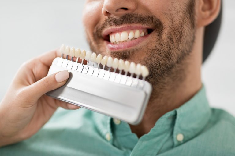 Man compares the shade of his teeth with prosthetic teeth to see effects of professional teeth whitening treatment