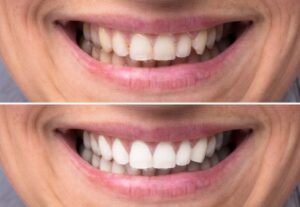 teeth Whitening - Before & After