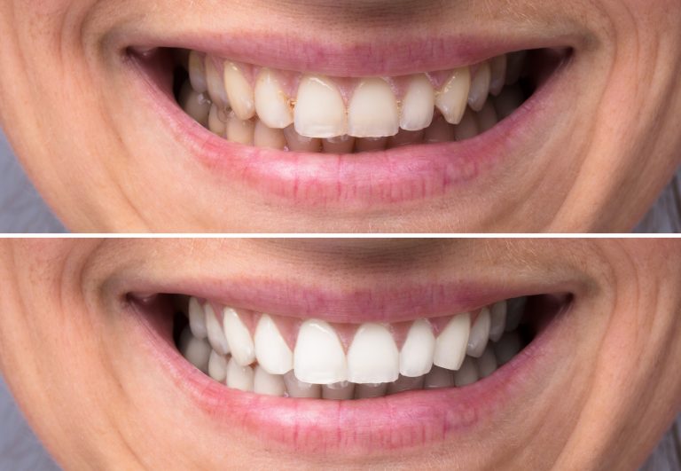 Before and after shots of a man's smile with whiter teeth