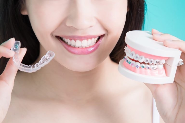 a girl with the clear aligners