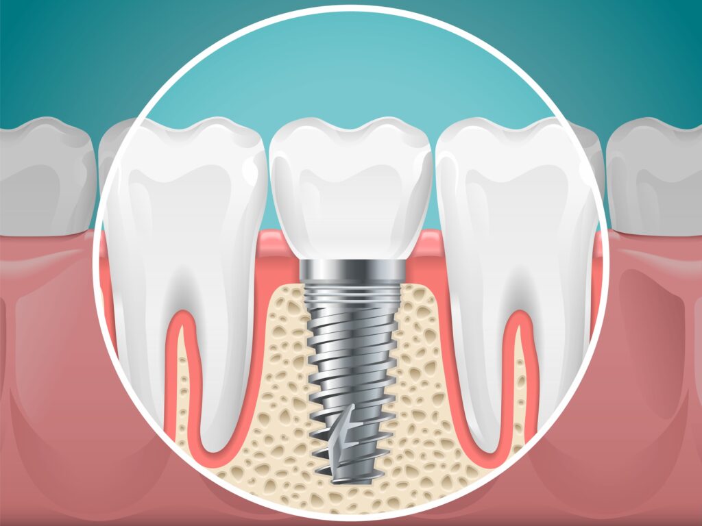 dental implants