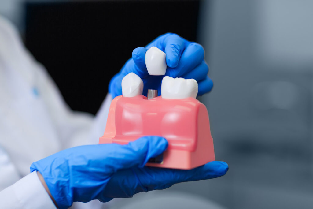 dental crown
