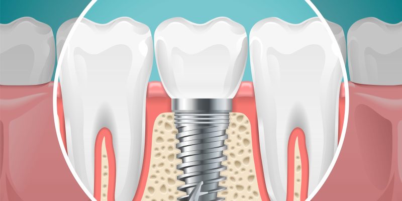 post img 7 dental implants