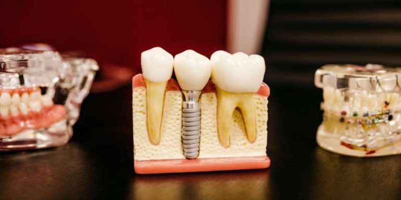 dental implants